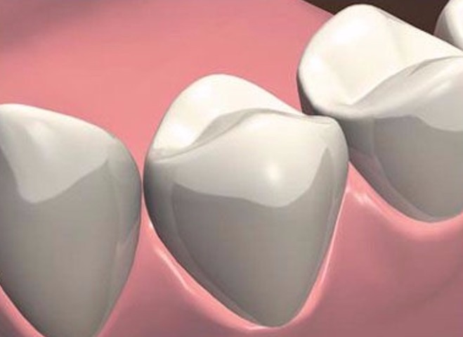 3-etap-implantacii-zuba